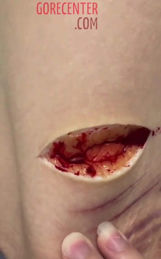 Deep cut on girl's arm • GoreCenter