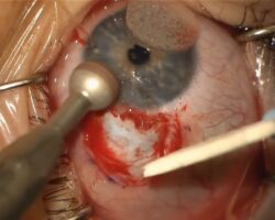 Surgical removal of limbal dermoid