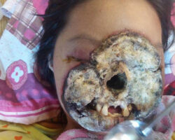 Young woman has her face destroyed by bacterial infection